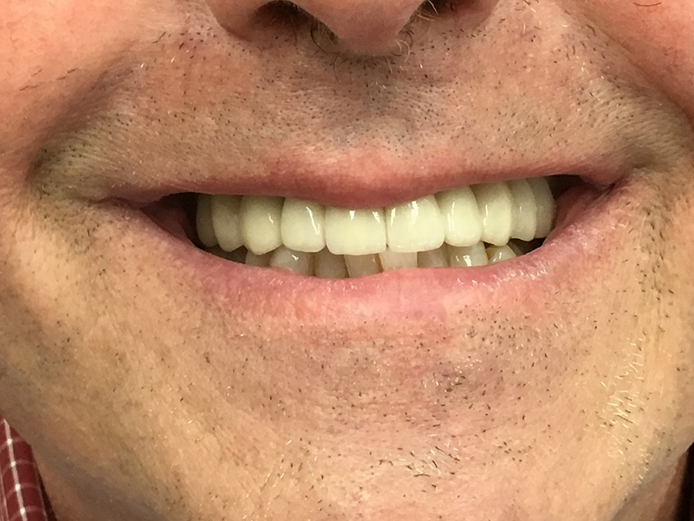 After - Implant Crown and Bridge
