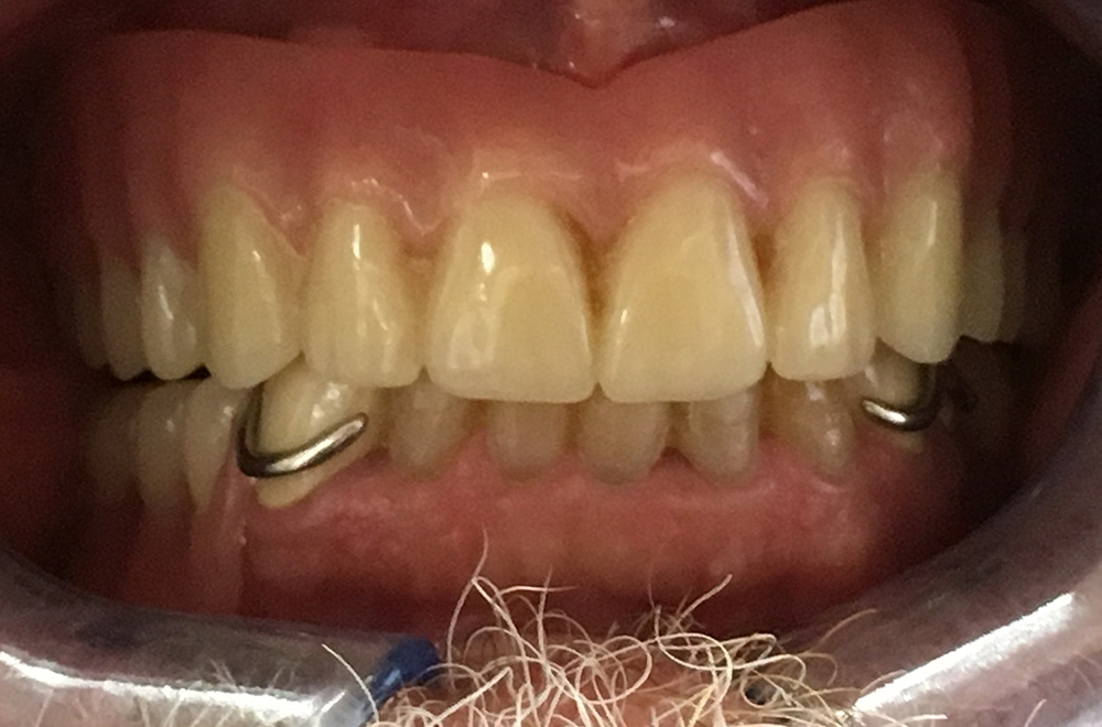 After - Implant Over Denture