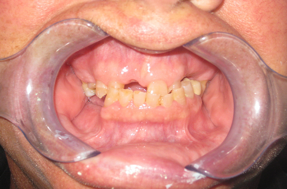 Before - Worn Dentition