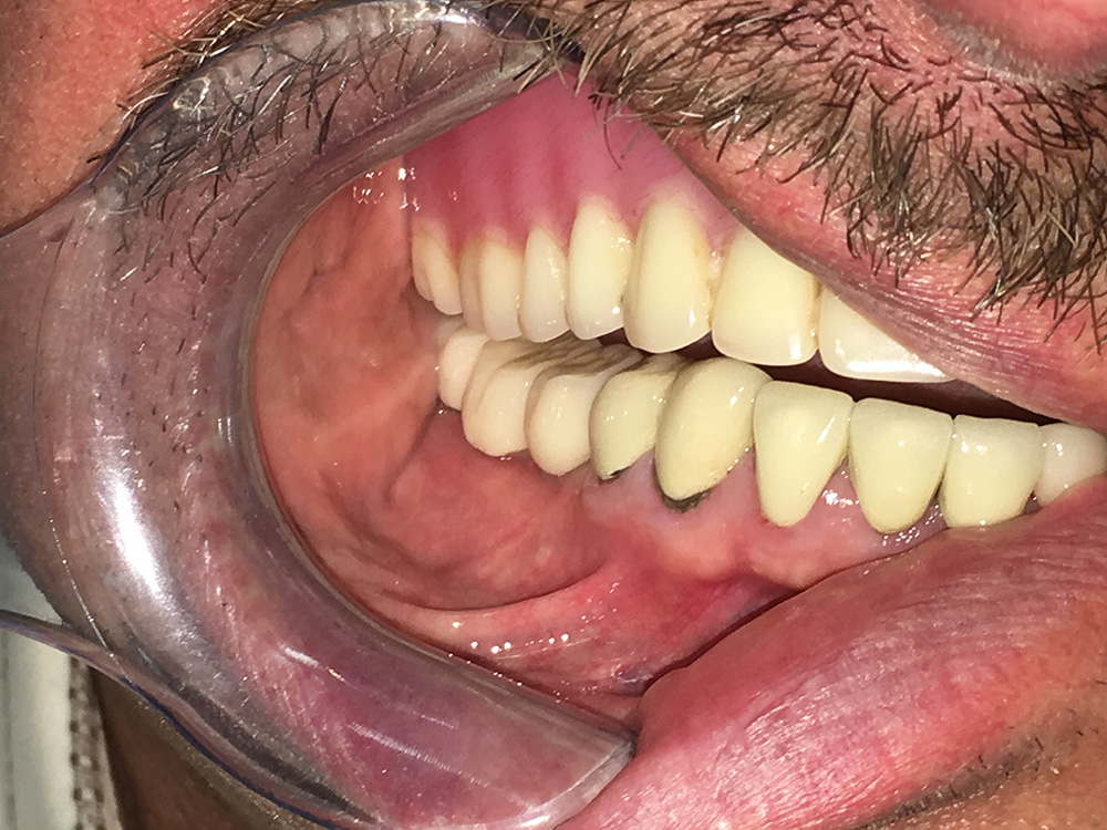 After - Implant Crowns