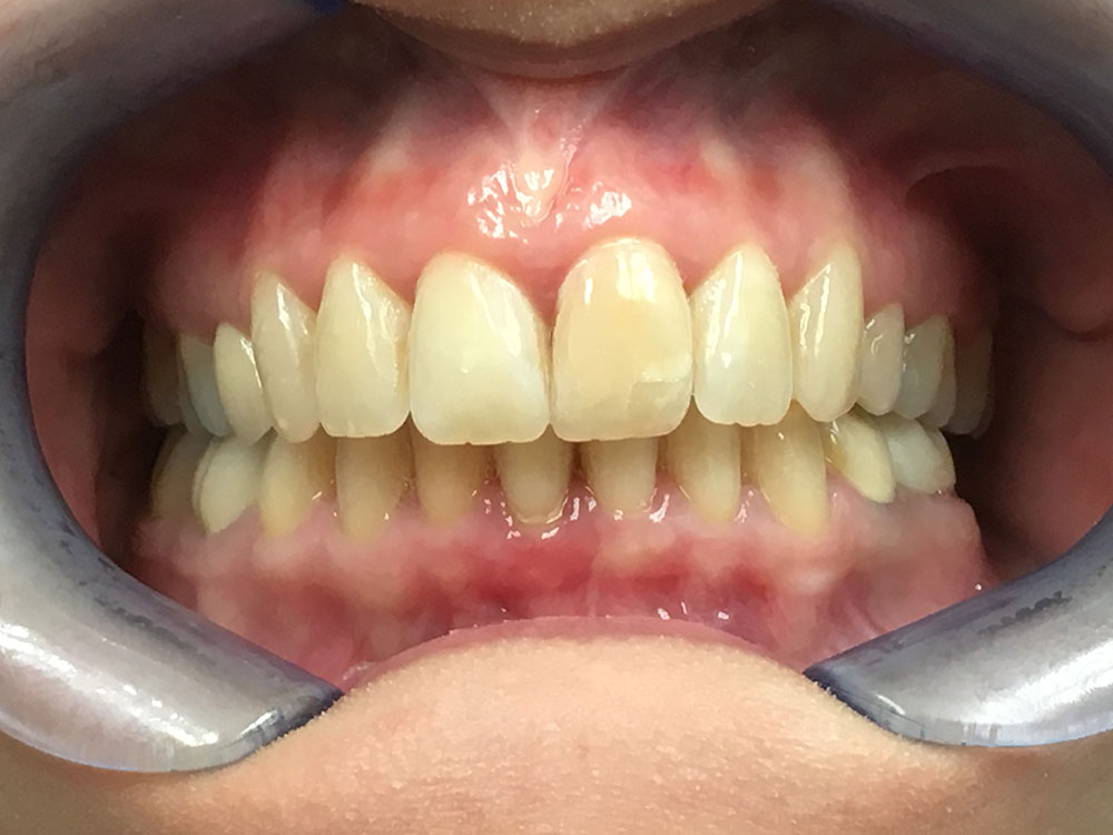 After - Invisalign
