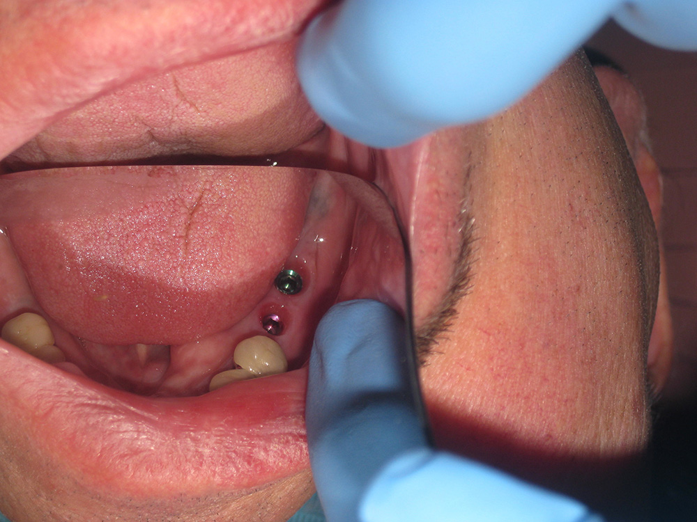 Before - Implant Crowns