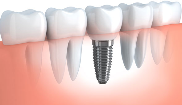 Dental Implant below the gums and crown above the gums
